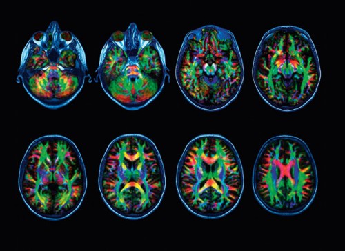 met-het-ouder-worden-vormen-hersenen-meer-langeafstandsverbindingen